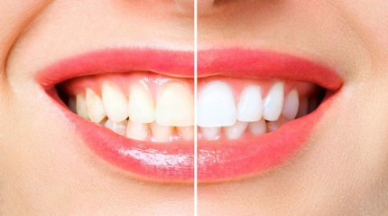 Brighter Smile with These Easy Teeth Whitening Techniques