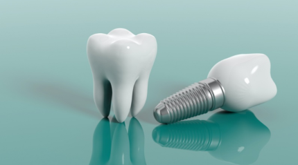The Benefits of Dental Implants for a Better Smile
