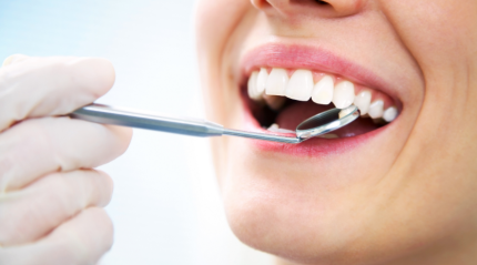 The Benefits and Process of Getting Dental Veneers