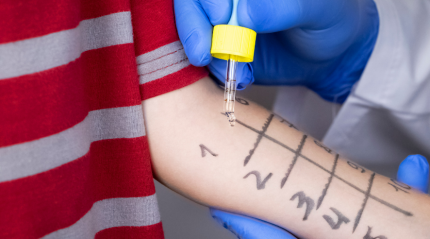 Dermatitis Skin: Causes, Symptoms, and Treatment